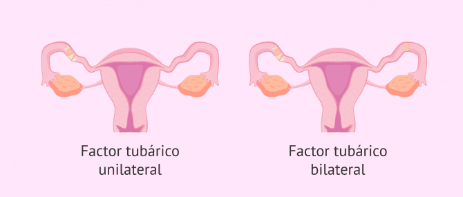 Imagen: Tipos de factor tubárico