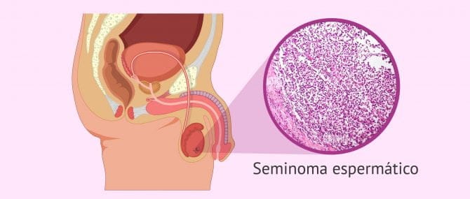 Imagen: Seminoma espermatocítico