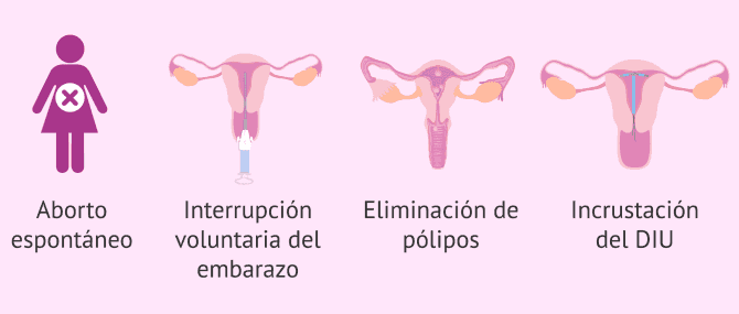 Imagen: Indicaciones para un legrado uterino