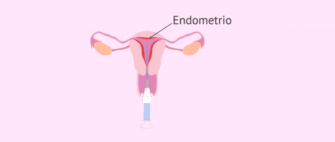 Imagen: Legrado o raspado del endometrio