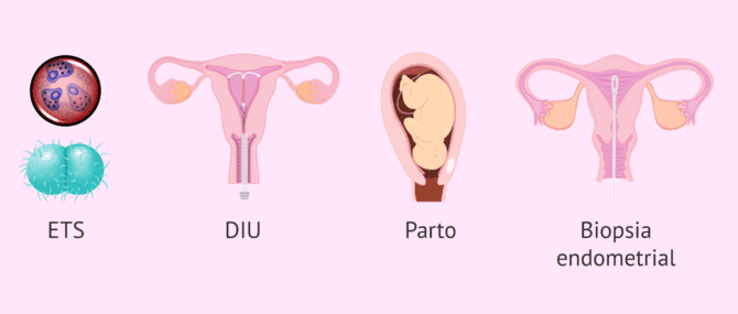 Imagen: Principales causas de la salpingitis