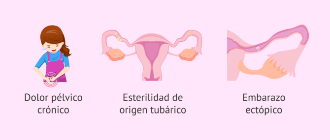 Imagen: ¿Qué complicaciones puede provocar la salpingitis?