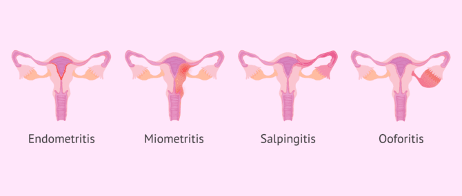 Imagen: Tipos de enfermedades inflamatorias pélvicas (EIP)