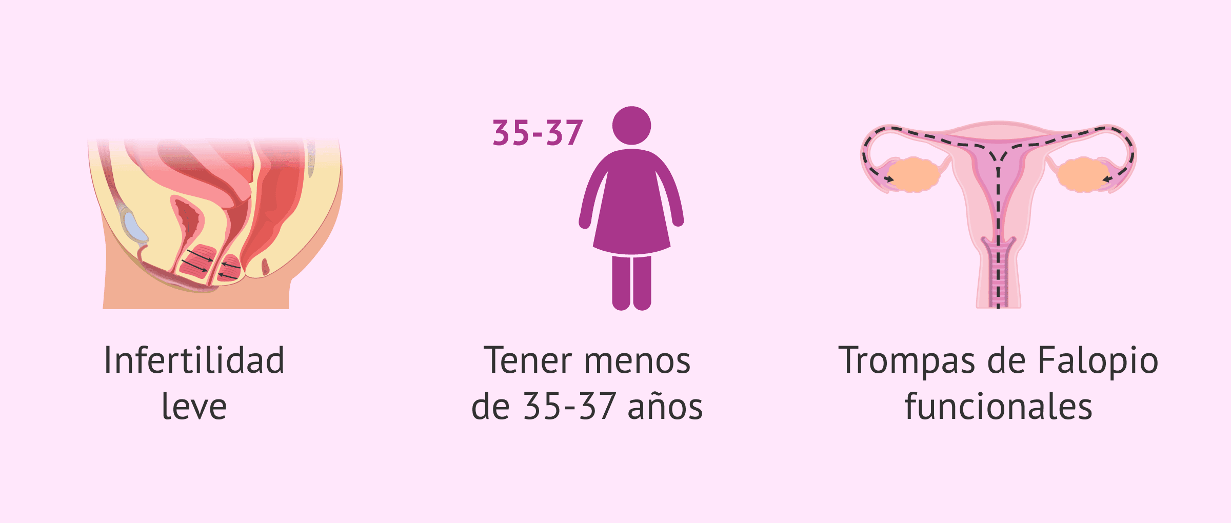 Imagen: Requisitos para IA en mujeres con problemas de fertilidad