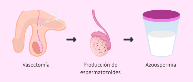 Imagen: ¿Puedo tener un hijo tras la vasectomía?