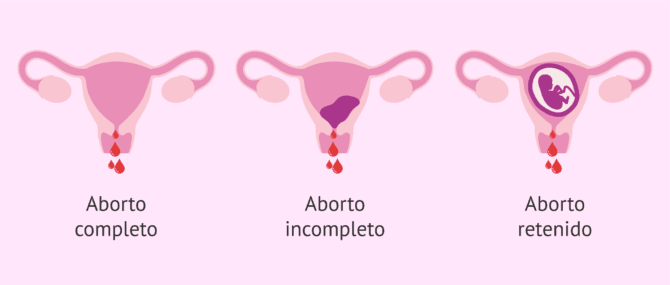 Imagen: Tipos de aborto según la variedad clínica