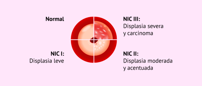 Imagen: ¿Qué grados hay de displasia cervical?