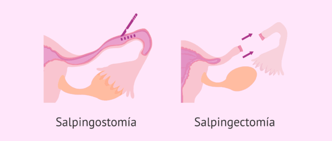 Imagen: Salpingostomía y salpingectomía para el tratamiento el embarazo ectópico