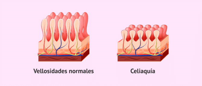 Imagen: Vellosidades intestinales en pacientes con celiaquía