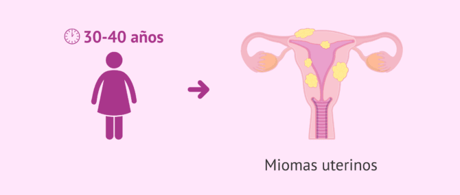 Imagen: ¿Qué es un mioma y cuándo se diagnostica?