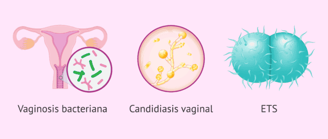 Imagen: Posibles causas de un flujo vaginal anormal