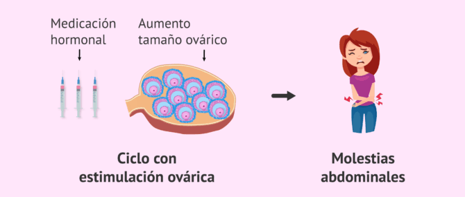 Imagen: Molestias por la estimulación ovárica