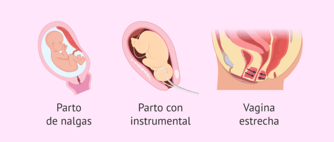 Imagen: ¿Cuándo está indicada la episiotomia?