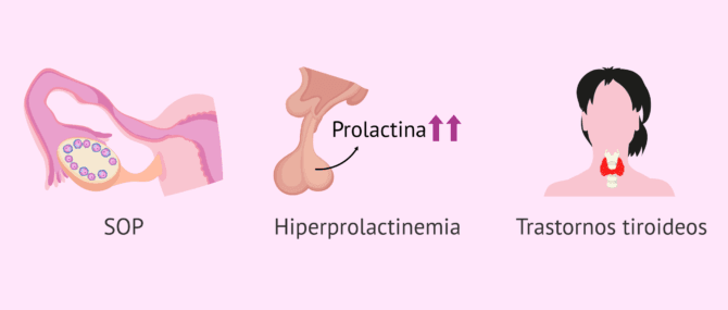 Imagen: Anovulación por alteraciones hormonales