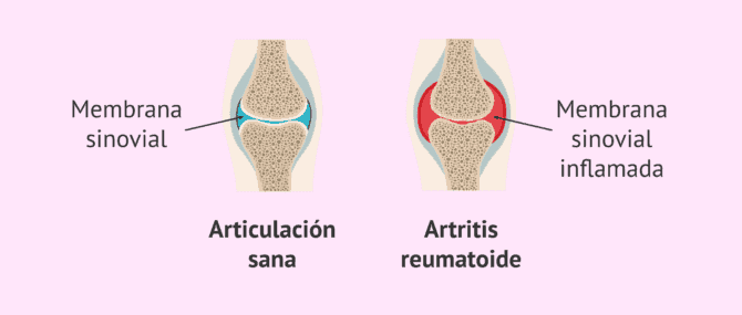 Imagen: Artritis reumatoide, una enfermedad autoinmune