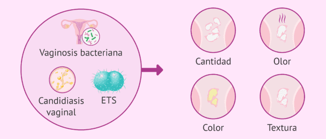 Imagen: Posibles causas de cambios en el flujo vaginal