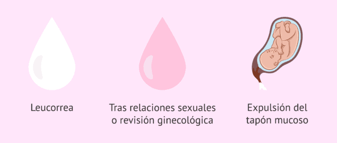 Imagen: Diferentes tipos de flujo vaginal durante el embarazo