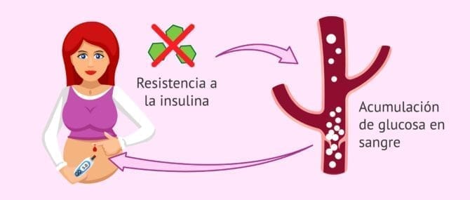 Imagen: Bloqueo insulina en el embarazo