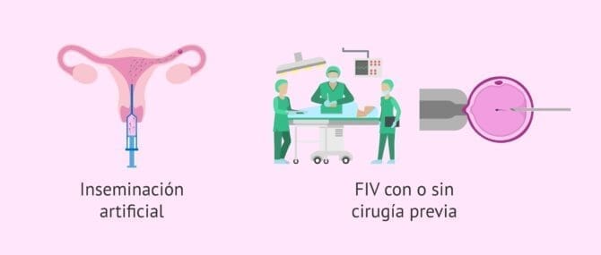 Imagen: Tipos de la endometriosis