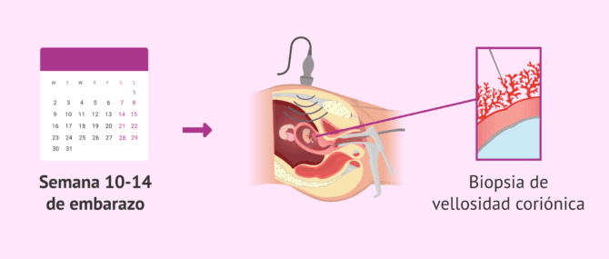 Imagen: ¿Cuándo se hace la biopsia corial?