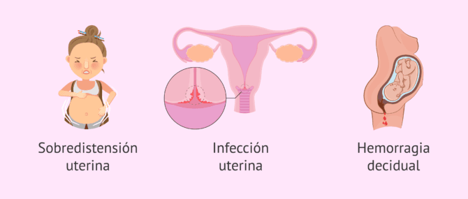 Imagen: ¿Cuáles son las causas del parto pretérmino