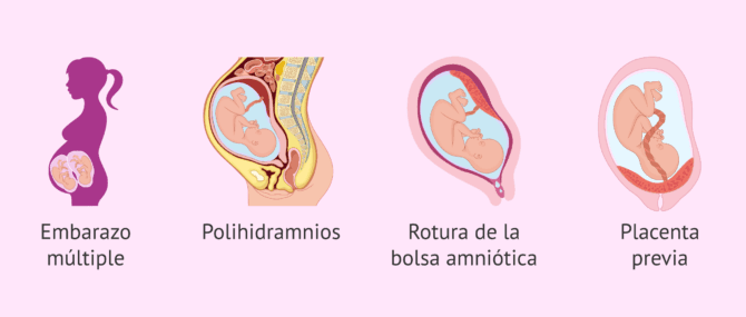 Imagen: Factores de riesgo durante el embarazo para el parto prematuro