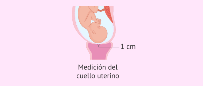 Imagen: ¿Cuánto mide el cuello uterino en el parto pretérmino?