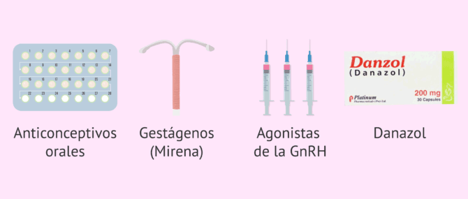 Imagen: Tratamiento hormonal para la endometriosis