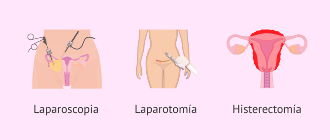 Imagen: Opciones quirúrgicas para la endometriosis