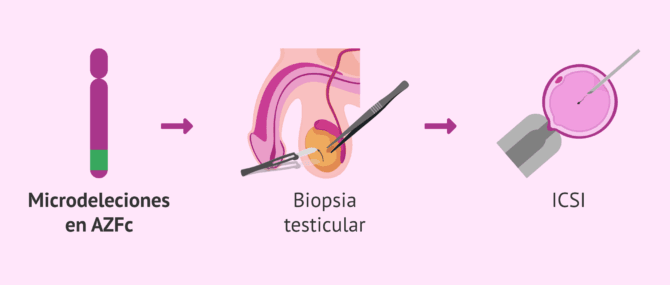 Imagen: Técnicas de reproducción asistida con microdeleciones en el cromosoma Y