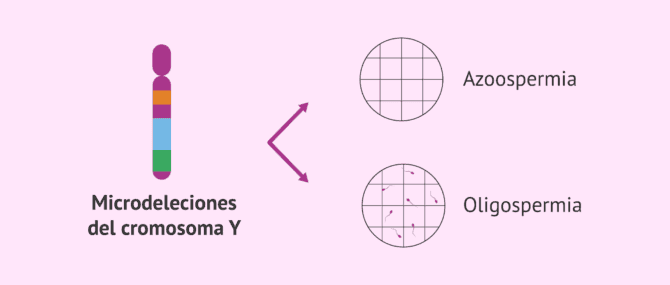 Imagen: Microdeleciones del cromosoma Y como causa de infertilidad masculina