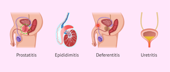 Imagen: ¿Qué infecciones seminales existen?