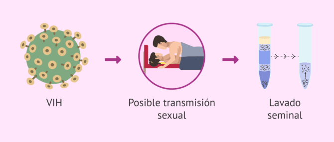 Imagen: Transmisión sexual del VIH y reproducción asistida