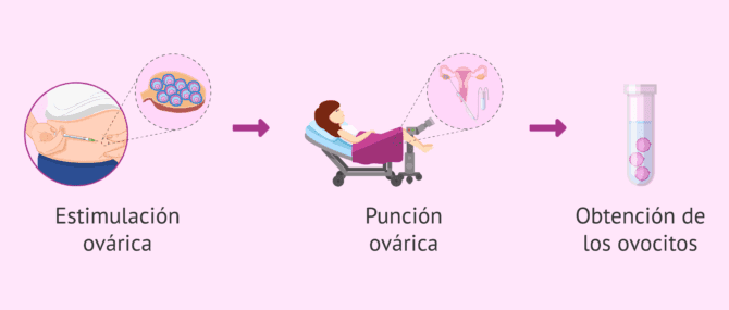 Imagen: ¿Por qué requiere anestesia la punción ovárica?