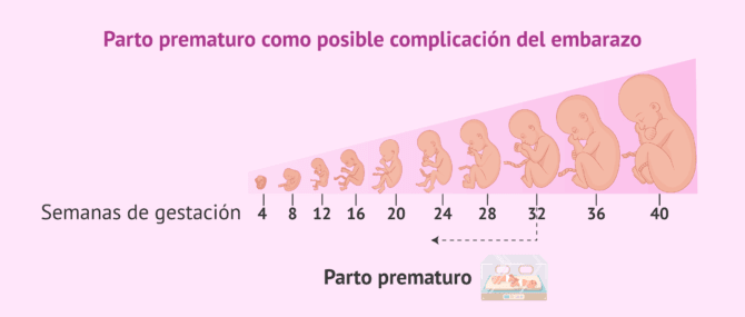 Imagen: Parto prematuro antes de la semana 32