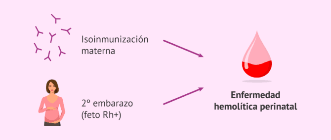 Imagen: Problemas en el segundo embarazo por la isoinmunización Rh materna