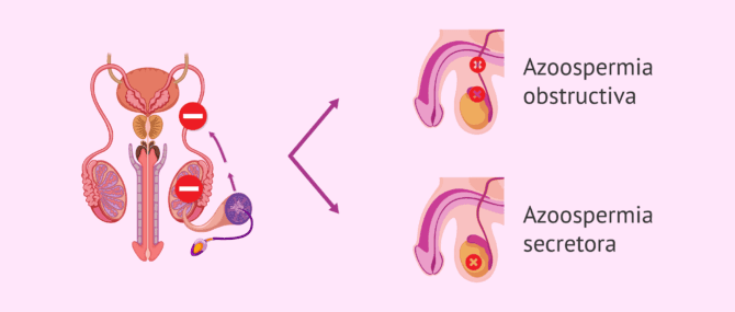 Imagen: Tipos de azoospermias: obstructiva y secretora