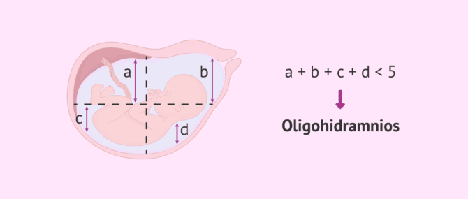 Imagen: Diagnóstico del oligohidramnios