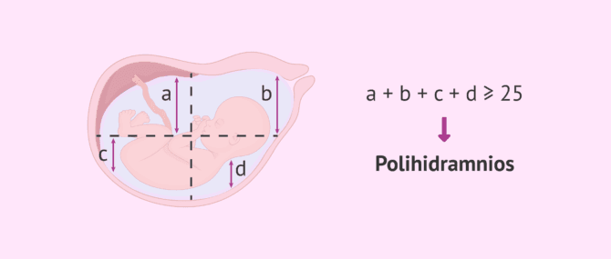 Imagen: Diagnóstico del polihidramnios