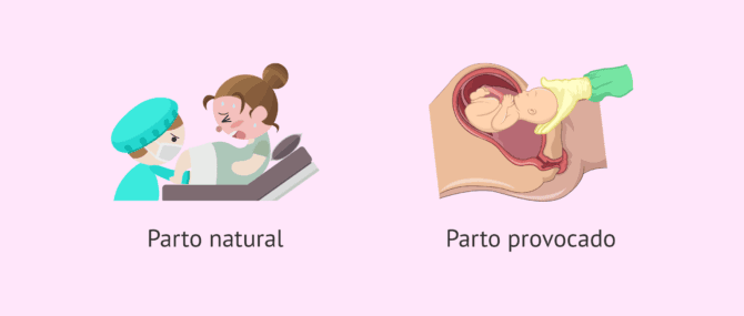 Imagen: Parto natural o parto inducido