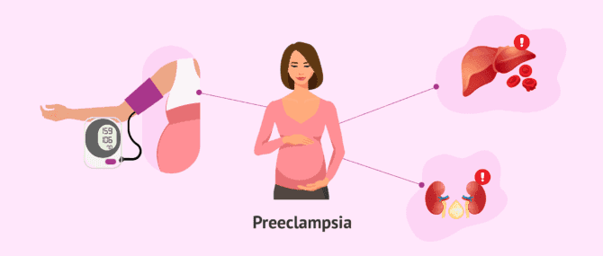 Imagen: ¿En qué consiste la preeclampsia?