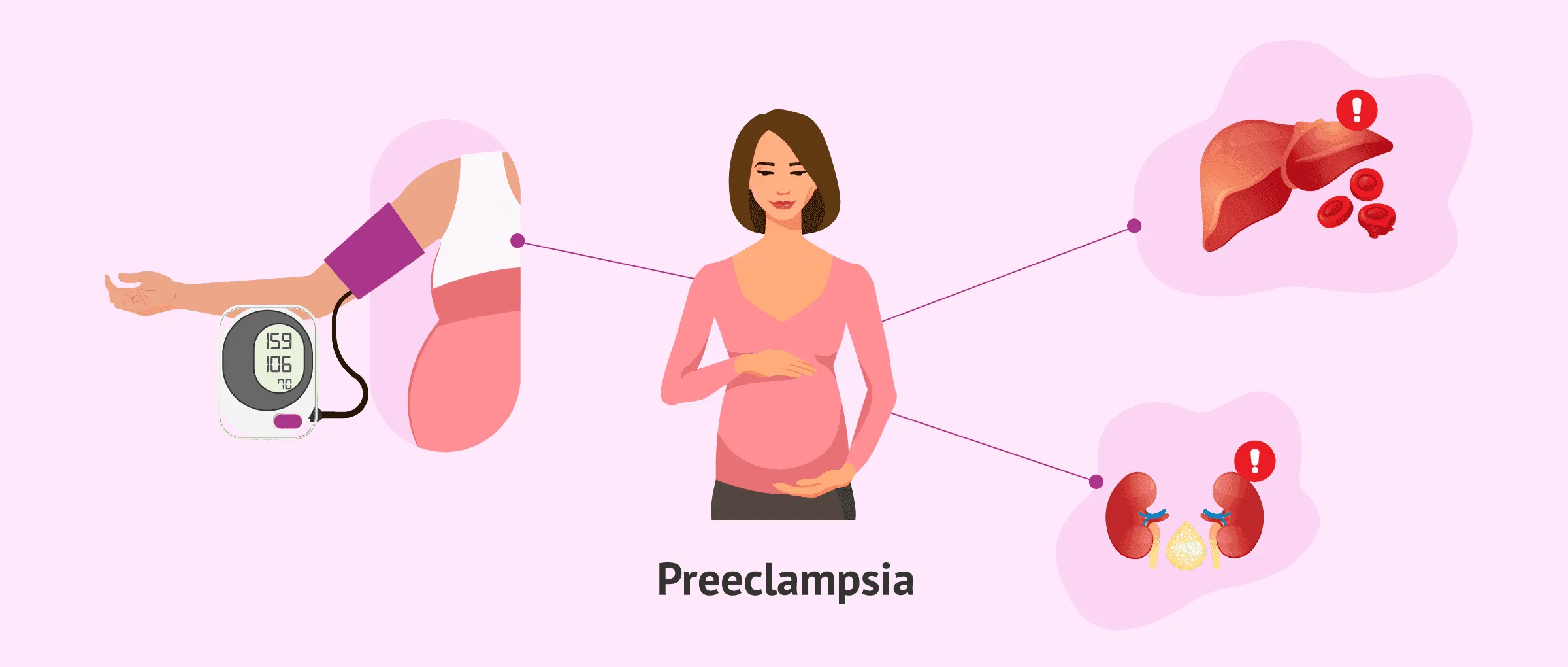 ¿En qué consiste la preeclampsia?