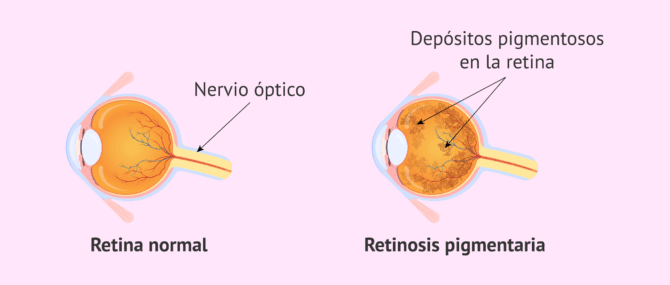 Imagen: Definición de retinosis pigmentaria