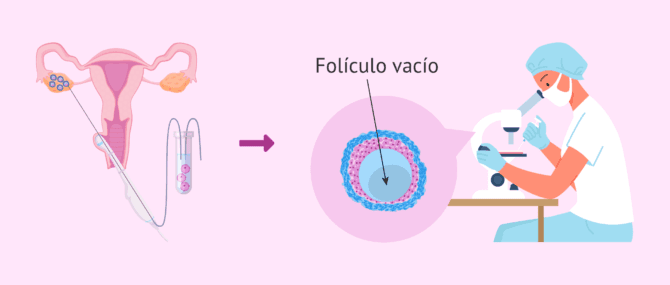 Imagen: ¿En qué consiste el síndrome del folículo vacío?