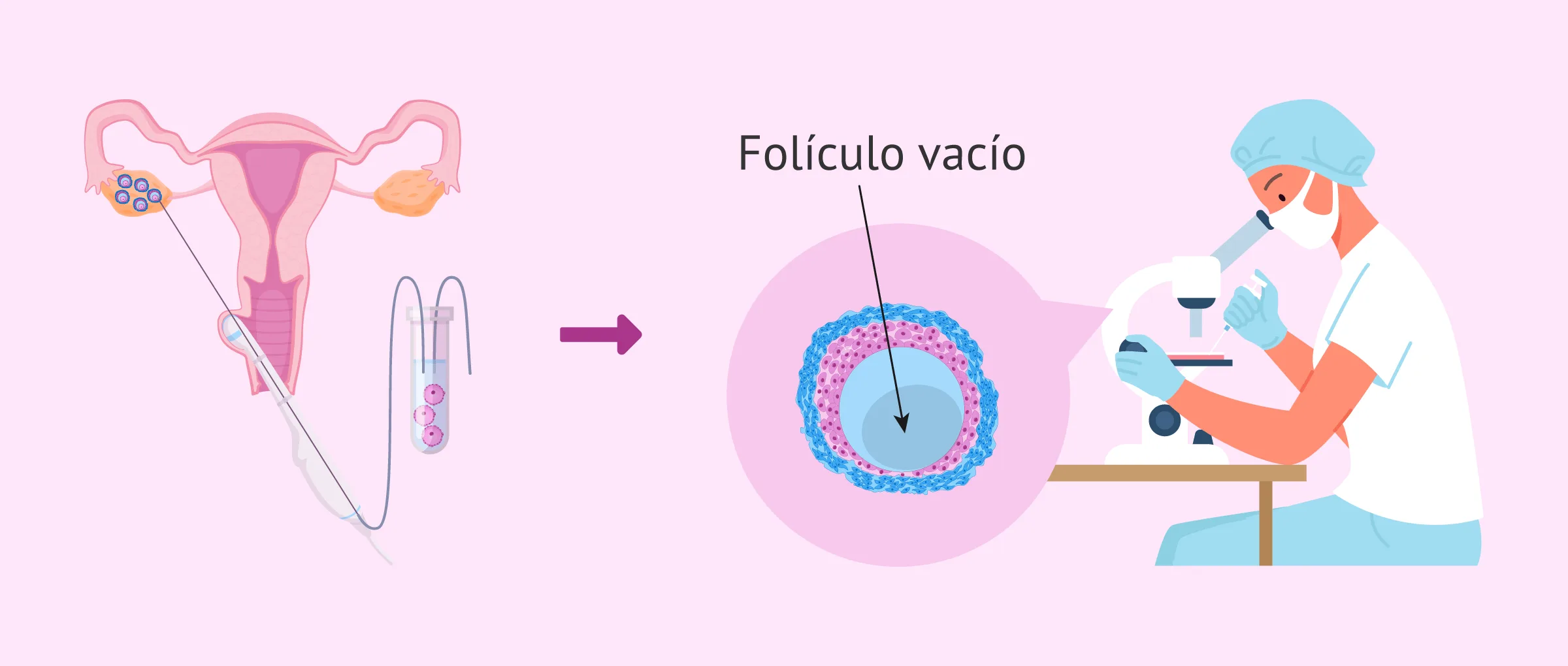 ¿En qué consiste el síndrome del folículo vacío?