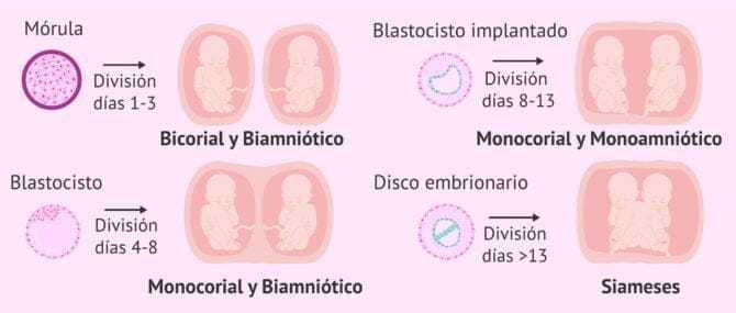 Imagen: Tipos de gemelos monocigóticos