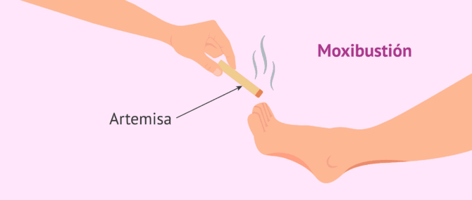 Imagen: Moxibustión para intentar que el bebé se gire