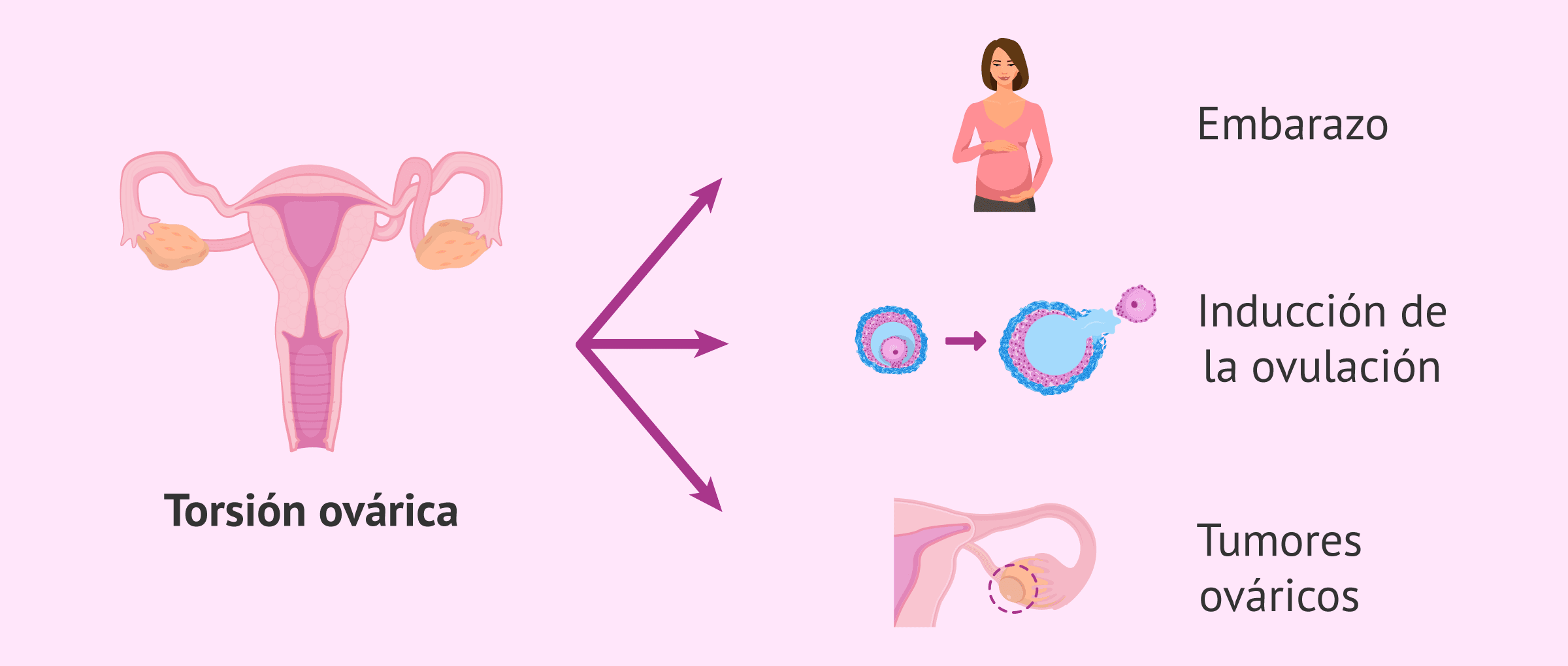 Imagen: Factores de riesgo para la torsión ovárica