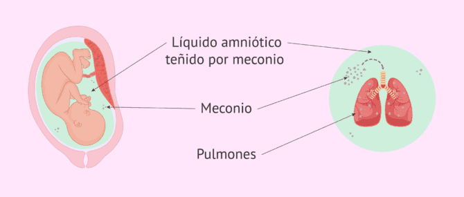 Imagen: Síndrome de aspiración meconial (SAM)