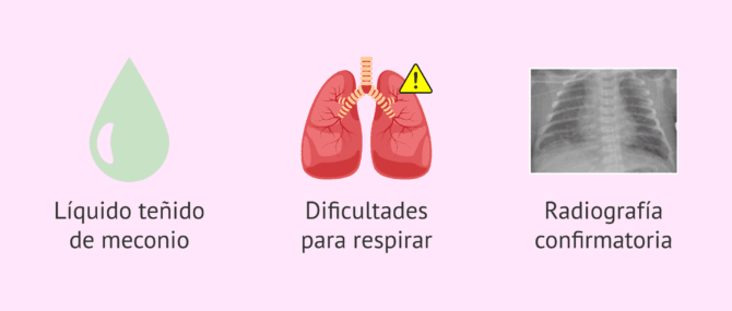 Imagen: Diagnóstico del síndrome de aspiración meconial (SAM)